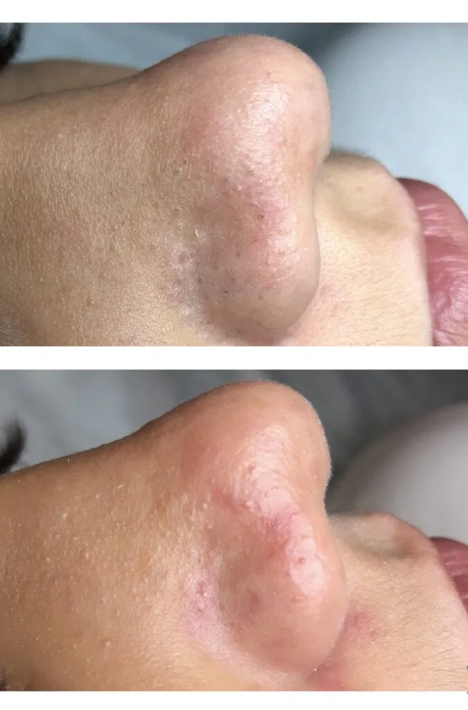 Foto real de antes e depois de extração — registro do consultório Estetiza