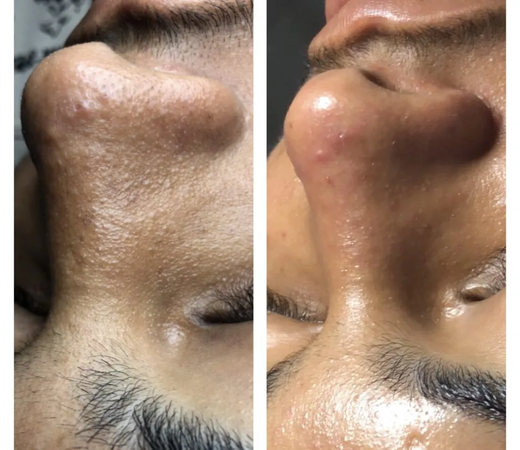 Foto real de antes e depois de extração — registro do consultório Estetiza