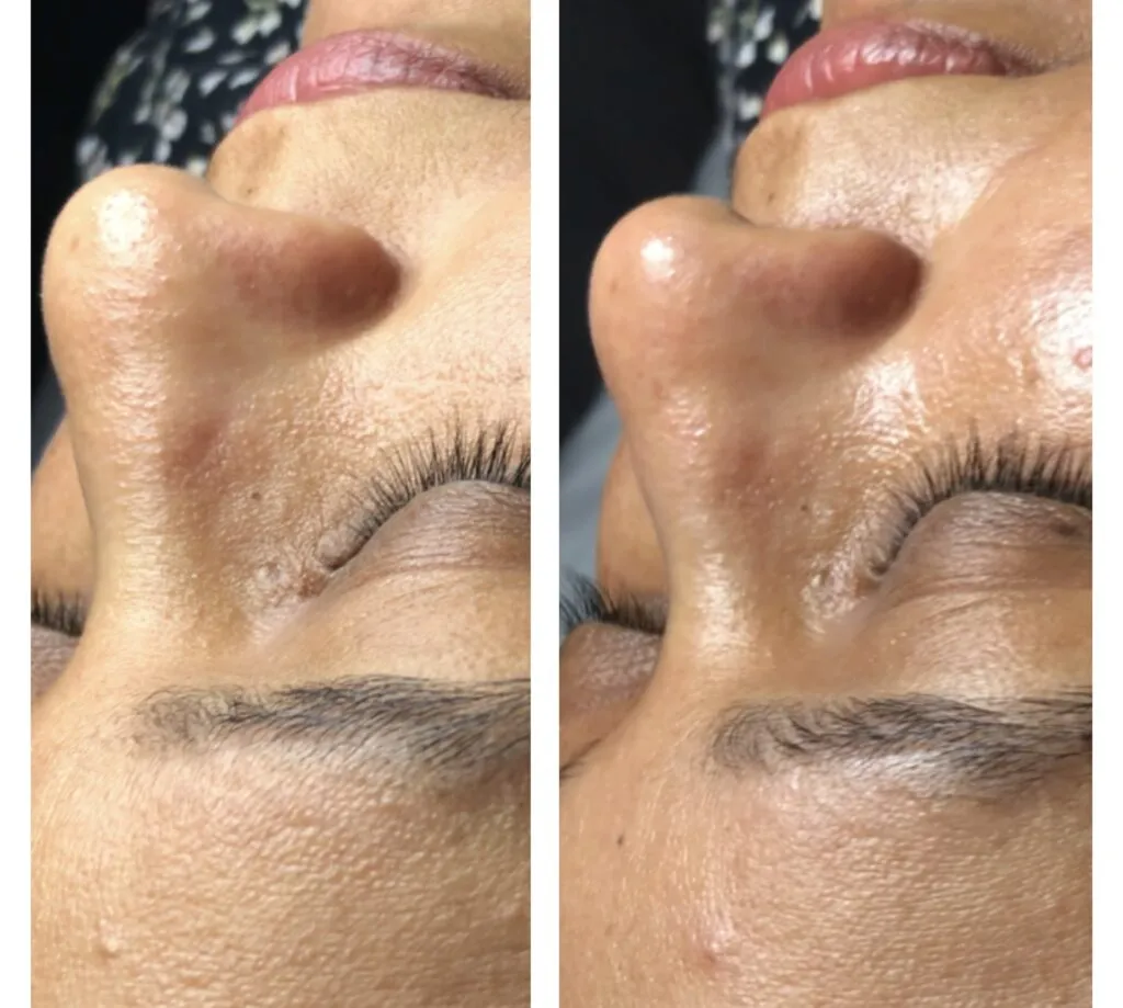 Foto real de antes e depois de extração — registro do consultório Estetiza