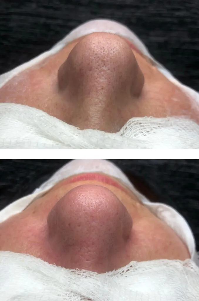 Foto real de antes e depois de extração — registro do consultório Estetiza
