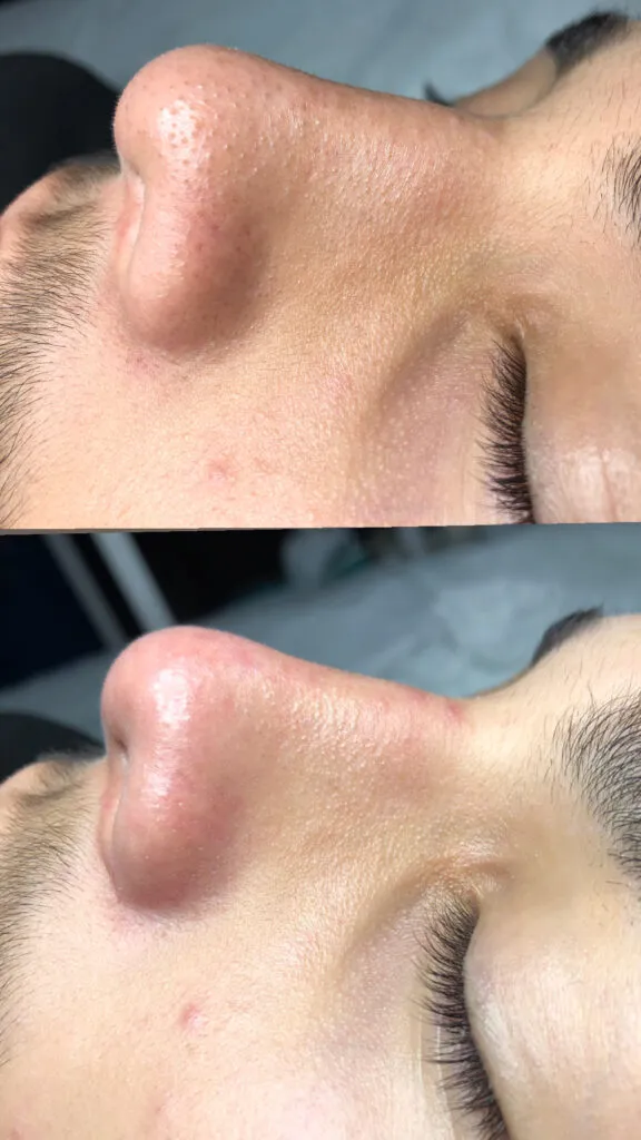 Foto real de antes e depois de extração — registro do consultório Estetiza
