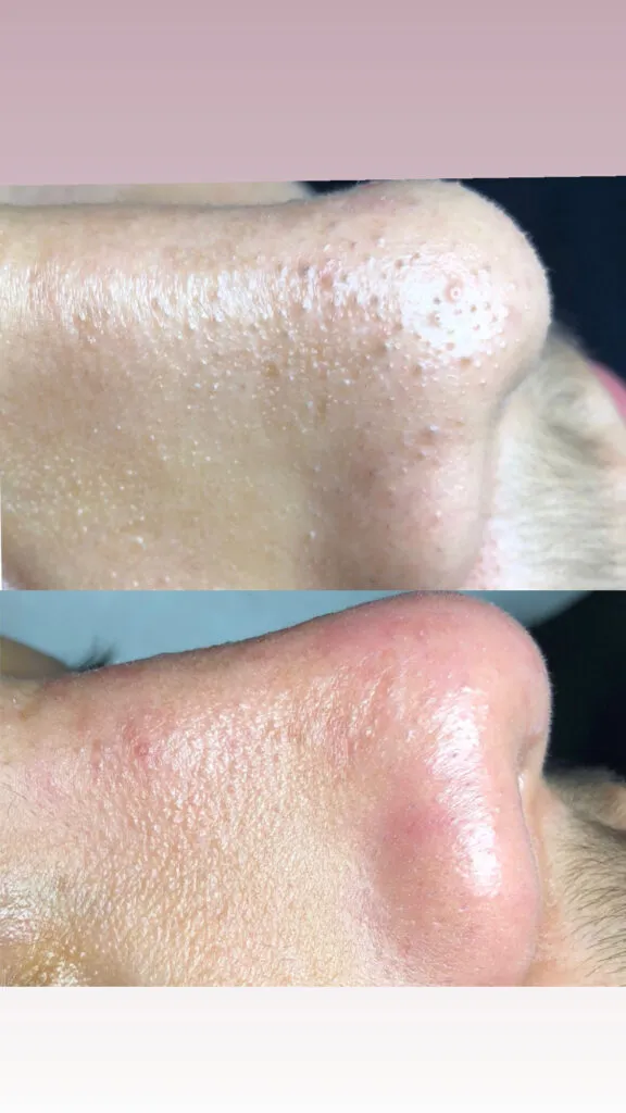 Foto real de antes e depois de extração — registro do consultório Estetiza