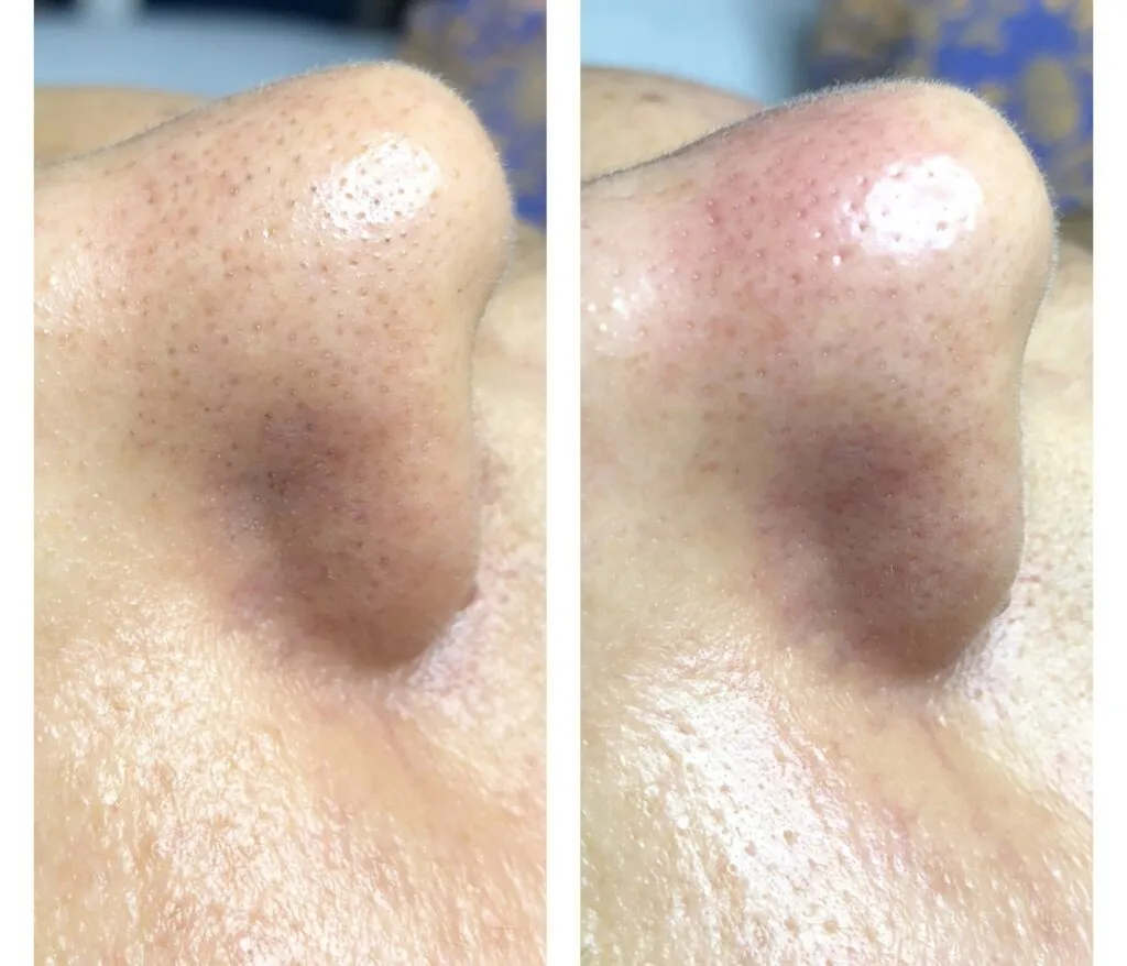 Foto real de antes e depois de extração — registro do consultório Estetiza
