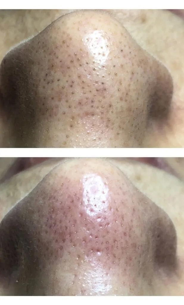 Foto real de antes e depois de extração — registro do consultório Estetiza