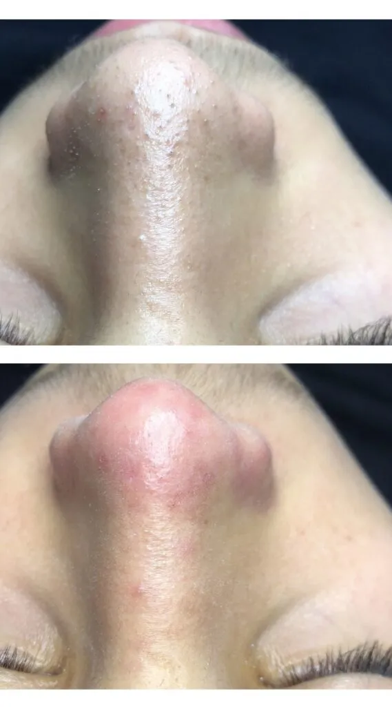 Foto real de antes e depois de extração — registro do consultório Estetiza