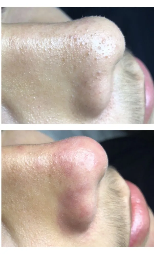 Foto real de antes e depois de extração — registro do consultório Estetiza