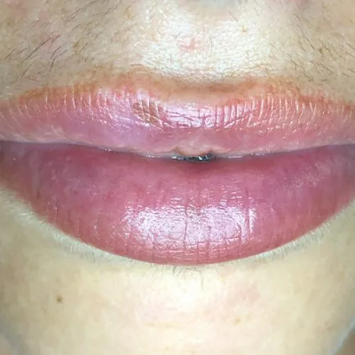 hidrogloss-antes